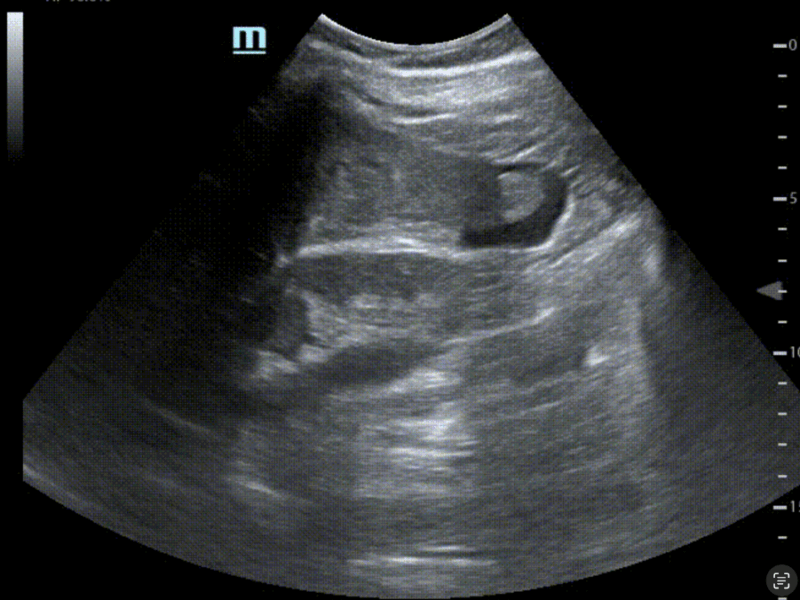 FAST et eFAST échographie : Définition, indications et réalisation